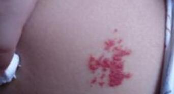 濮陽手術(shù)吸脂減肥治療費用公布(濮陽亞星智美醫(yī)療美容門診部手術(shù)吸脂減肥參考價：3966元)