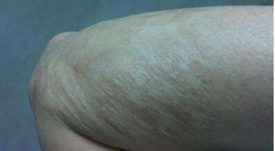 石家莊頸部皺紋祛除手術(shù)治療價格表詳細展示(石家莊新華區(qū)漢芳東購醫(yī)療美容診所頸部皺紋祛除手術(shù)參考價：3139元)