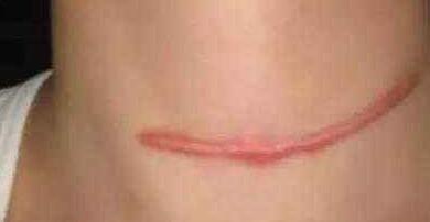 韓國(guó)負(fù)壓吸黑頭價(jià)格