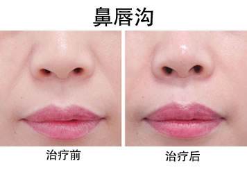 長沙面部抗衰老手術價格到底是多少呀(長沙開福笙澤醫(yī)療面部抗衰老手術參考價：6857元)