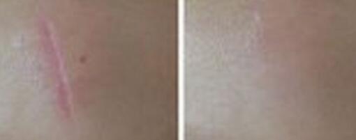 山西紅藍(lán)光去痘價格