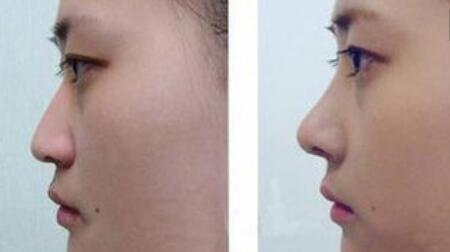 蘭州自體脂肪填充凹陷疤痕的價(jià)位分享(蘭州第一人民醫(yī)院整形科自體脂肪填充凹陷疤痕參考價(jià)：4813元)