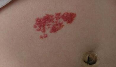 寧波面部美容熱瑪吉手術(shù)費(fèi)用查看(寧波神話澤潤醫(yī)療美容門診部面部美容熱瑪吉參考價(jià)：3399元)