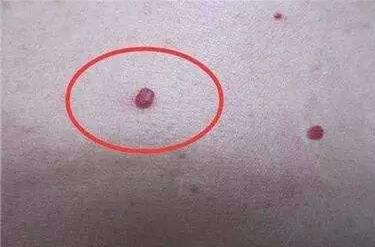 上海超聲刀祛雀斑價(jià)格表收費(fèi)分享(上海交通大學(xué)附屬人民醫(yī)院整形外科超聲刀祛雀斑參考價(jià)：3098元)