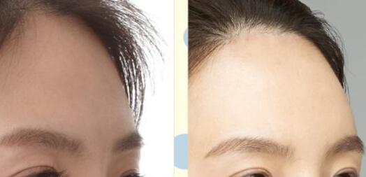 寧波光子祛除黃褐斑價格