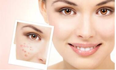 溫嶺納米微針去動態(tài)細(xì)紋費(fèi)用大概用多少(臺州溫嶺美諾整形醫(yī)院納米微針去動態(tài)細(xì)紋參考價：5762元)