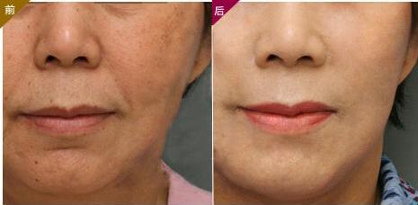 上海電波拉皮去除妊娠紋治療價(jià)目表收費(fèi)標(biāo)準(zhǔn)公開(上海瑞歐醫(yī)療美容門診部電波拉皮去除妊娠紋參考價(jià)：5940元)