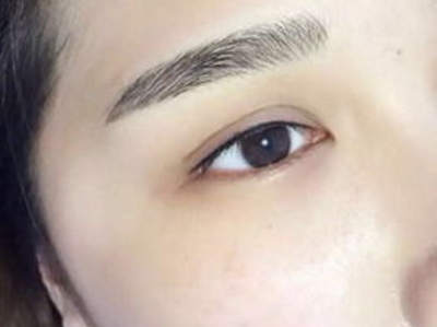 成都肉毒素祛疤痕增生價(jià)格價(jià)錢(qián)表在線公布(成都友誼醫(yī)院整形美容外科肉毒素祛疤痕增生參考價(jià)：4808元)