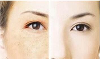 廣州頸紋手術(shù)去除價格