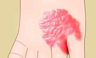 武漢電波拉皮去除眼周細(xì)紋的費(fèi)用一般需要多少價(jià)格(武漢大學(xué)人民醫(yī)院整形科電波拉皮去除眼周細(xì)紋參考價(jià)：6966元)