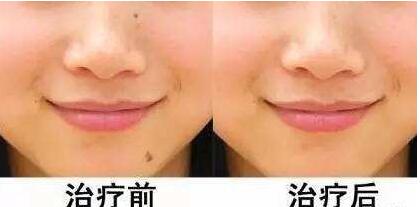 海南點(diǎn)陣激光祛木偶紋價(jià)格表2023全面發(fā)布(海南省腫瘤醫(yī)院醫(yī)學(xué)美容科點(diǎn)陣激光祛木偶紋參考價(jià)：5065元)