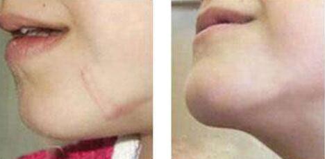 蘇州玻尿酸去眼周細(xì)紋的手術(shù)費(fèi)用詳細(xì)一覽(蘇州中西醫(yī)結(jié)合醫(yī)院整形科玻尿酸去眼周細(xì)紋參考價(jià)：5122元)