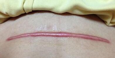 開封膠原蛋白注射填充去痘疤收費標(biāo)準(zhǔn)明細(xì)公布(開封晴美醫(yī)療美容膠原蛋白注射填充去痘疤參考價:5459元)