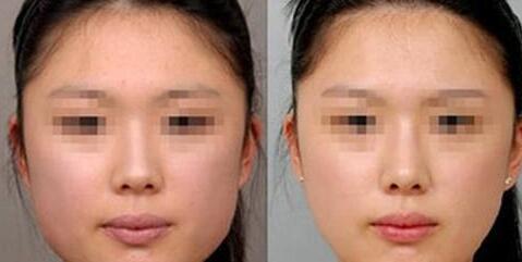 長沙做去黑痣報(bào)價(jià)整形費(fèi)用(長沙欣姿美醫(yī)療美容門診部做去黑痣?yún)⒖純r(jià)：4703元)