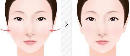 新鄉(xiāng)激光去黑色素痣的手術(shù)費(fèi)用需要多少錢合理(新鄉(xiāng)371醫(yī)院整形美容科激光去黑色素痣?yún)⒖純r(jià)：3208元)