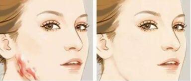 重慶眼角去痣價(jià)格