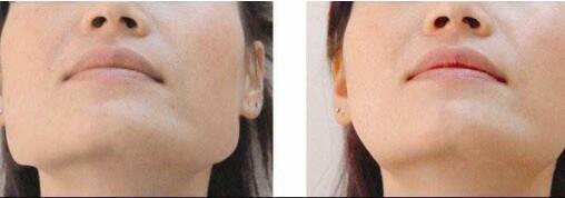 寧波硅膠假體植入豐額頭治療價格表巨惠出爐(寧波海曙天一整形醫(yī)院硅膠假體植入豐額頭參考價：5019元)