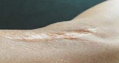 岳陽做墊下巴大概需要手術(shù)費用多少錢(岳陽禾美薈醫(yī)療美容做墊下巴參考價：3922元)