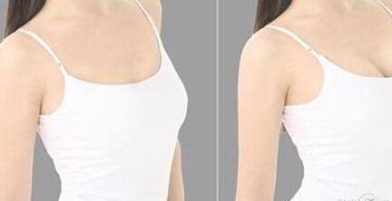 廣州脂肪填充凹陷價格