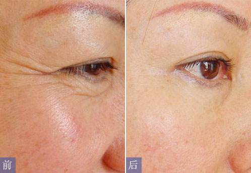 昆山大拉皮去動態(tài)細(xì)紋的手術(shù)費用一般需要多少錢(昆山德爾美客醫(yī)療美容門診部大拉皮去動態(tài)細(xì)紋參考價：6936元)