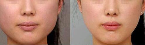 大連瘦針灸減肥的價(jià)錢查詢(大連鼎森醫(yī)療美容門診部瘦針灸減肥參考價(jià)：5377元)