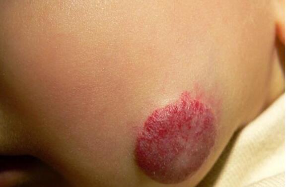 宿州減輕額頭皺紋價位表詳細展示(宿州埇橋區(qū)東關辦事處衛(wèi)生院減輕額頭皺紋參考價：6720元)