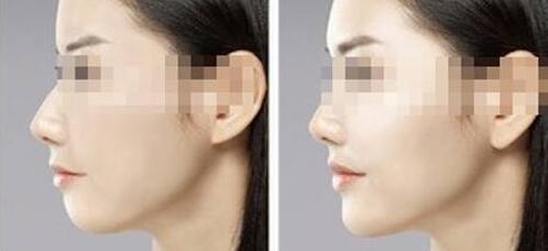 湖南面部美雕價格