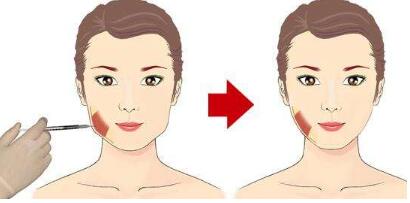 江門唇紋去除手術(shù)治療價目表出爐(廣東江門福康整形美容中心唇紋去除手術(shù)參考價：4688元)