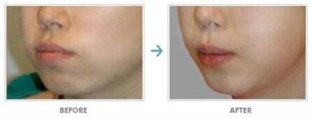 天津陰道前后壁膨出費用一般都要多少錢呢(天津御芝堂醫(yī)療美容門診部陰道前后壁膨出參考價：6664元)