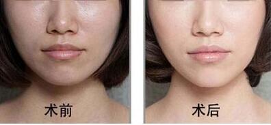 廣州抽脂瘦臉手術價格