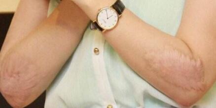 廣州嫩膚去痘印費(fèi)用2023免費(fèi)查詢(廣州奈斯醫(yī)療美容醫(yī)院嫩膚去痘印參考價(jià)：3733元)