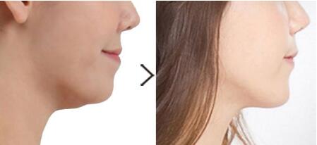 山東杯狀耳矯正整形費用價格(山東濱州曦朵醫(yī)療美容門診部杯狀耳矯正整形參考價：6562元)