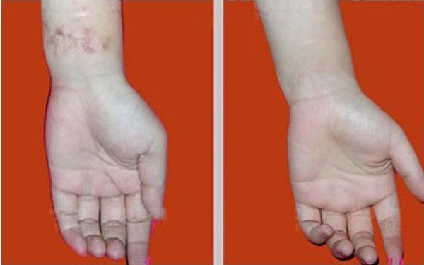 南京藝星超聲炮體驗分享，周敏醫(yī)生值得信賴！