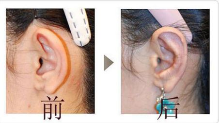 上海華山醫(yī)院顴骨整形效果如何？優(yōu)秀醫(yī)生推薦