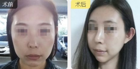 雙眼皮塑美，昆明藝星技術大揭秘，價格詳盡一覽