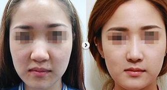 長春市中心醫(yī)院整形美容科像素激光去疤解析與特色診療服務(wù)