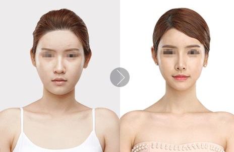 福州海峽整形美容醫(yī)院隆鼻手術(shù)效果評(píng)價(jià)