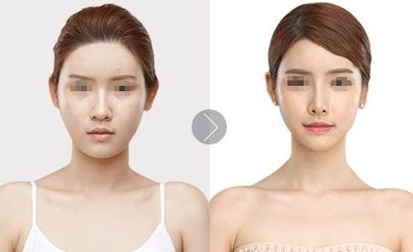 藝星合肥雙眼皮口碑如何？優(yōu)勢與費(fèi)用全解析